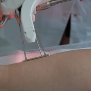 Laser Hair Removal In Central London