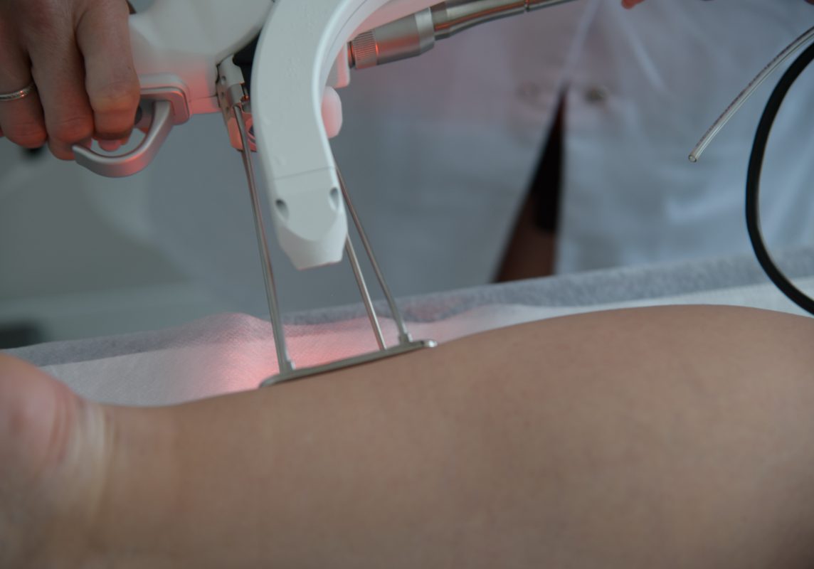Laser Hair Removal In Central London