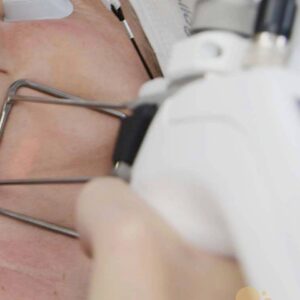 Laser Skin Treatment London