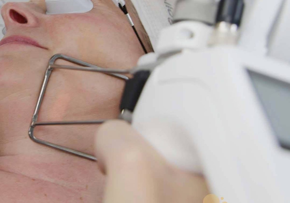 Laser Skin Treatment London