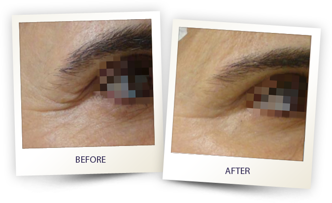 Eye before and after Eye before and after