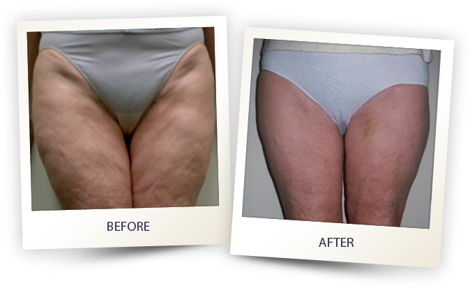 Legs before and after Legs before and after