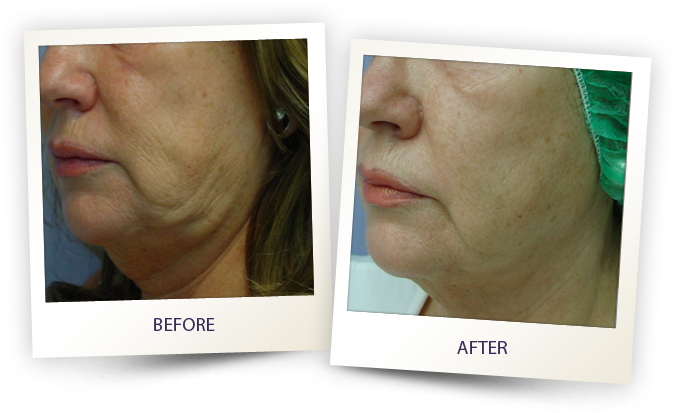 Cheek before and after 3 Cheek before and after 3